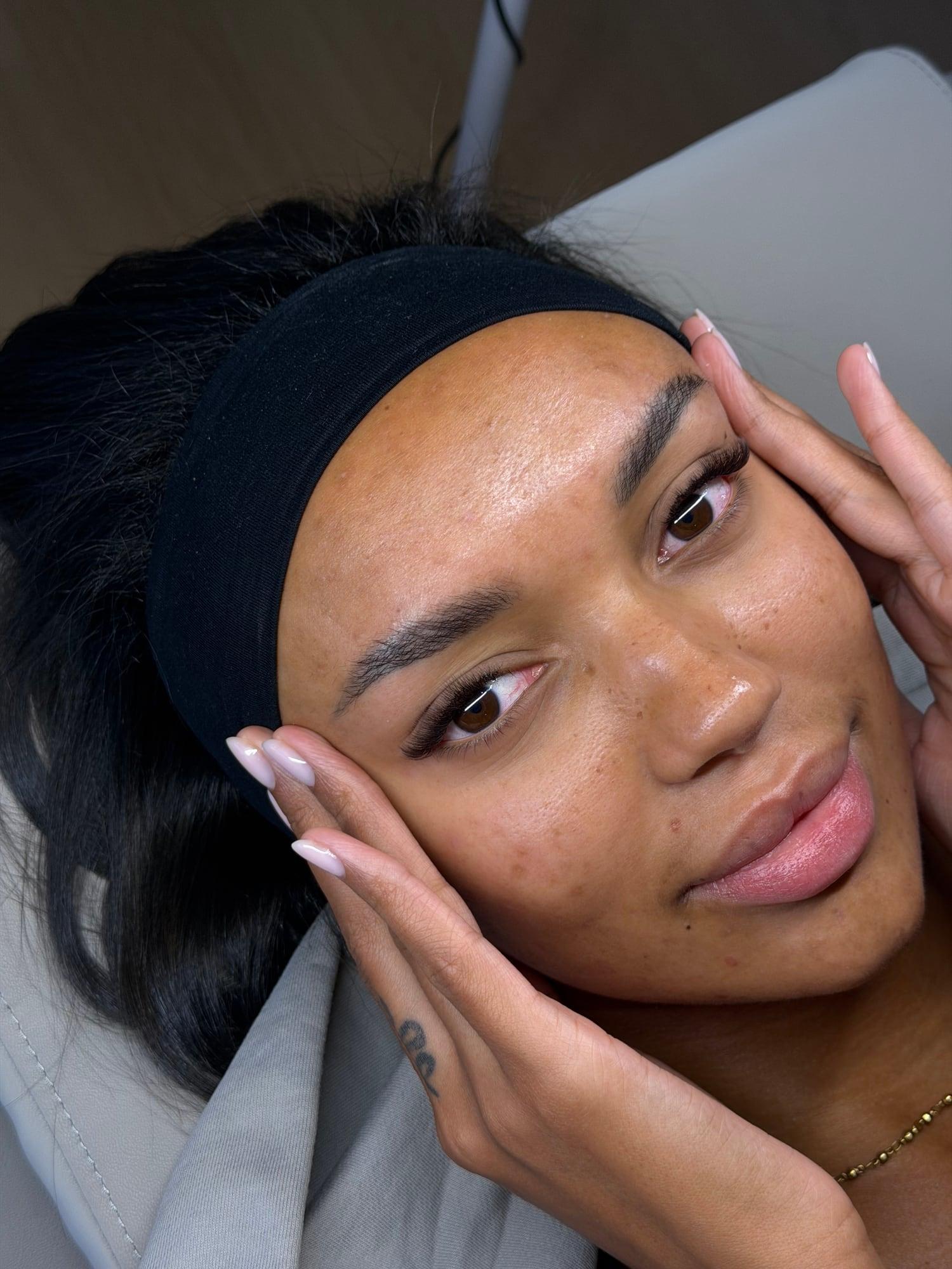 Sourcils restructurés juste après le soin, bandeau encore en place